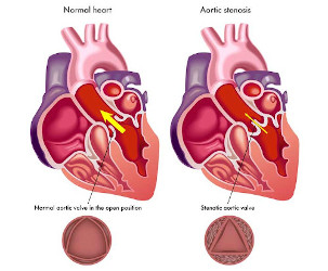 Non-invasive therapy of aortic stenosis: a successful first clinical trial