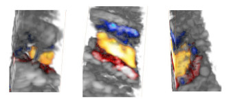 3D ultrafast ultrasound is the most cited paper in PMB over the past 5 years