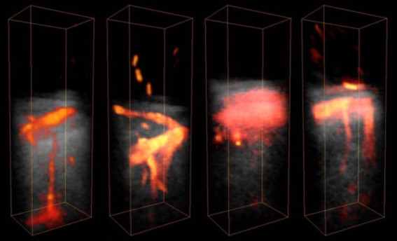 Ultrasound angiography of coronaries goes 3D