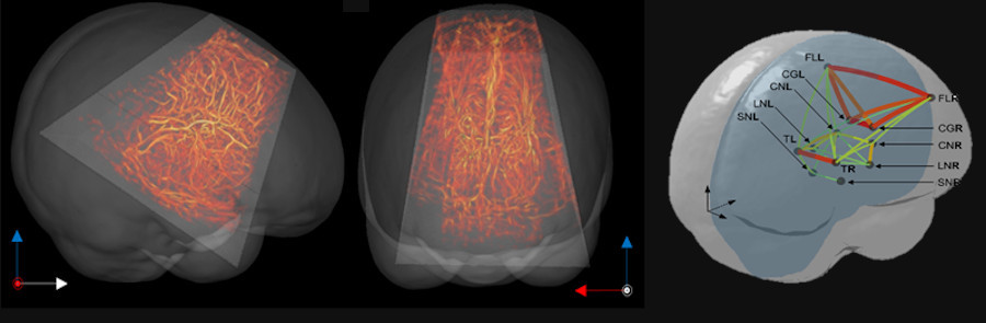 Functional ultrasound imaging reveals the dynamics of brain states in preterm babies