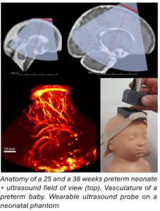 Research Internship : Realistic vascular and structural neonatal head  phantom to improve the optimization of neonatal functional ultrasound probes