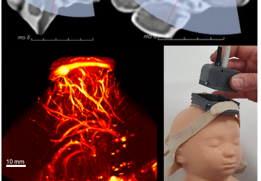 Research Internship : Realistic vascular and structural neonatal head  phantom to improve the optimization of neonatal functional ultrasound probes