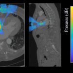 Numerical modeling for cardiac ultrasound therapy: new paper in IEEE Transactions on Biomedical Engineering
