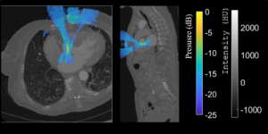 Our study in collaboration between Cardiawave and researchers from Physics for Medicine Paris presents a 3D numerical model of ultrasonic propagation through the ribcage, designed for applications in non-invasive cardiac ultrasound therapy.