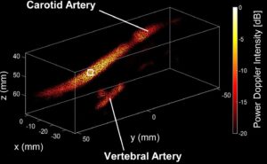 Hannah Plath, PhD student in our lab, has just published her first paper in Ultrasound in Medicine & Biology. Her work introduces a novel approach to imaging the human carotid artery in 4D that is, full 3D imaging captured over time, using a custom multi-lens probe designed for wide-field coverage.