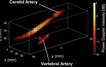 New Publication in Ultrasound in Medicine & Biology: 4D Wide-Field Ultrafast Ultrasound of the Human Carotid Using a Multi-Lens Probe
