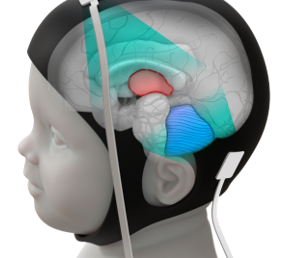 Design of optimal wearable ultrasound probe for neonatal functional ultrasound imaging using an in silico realistic brain phantom and in vitro validation.